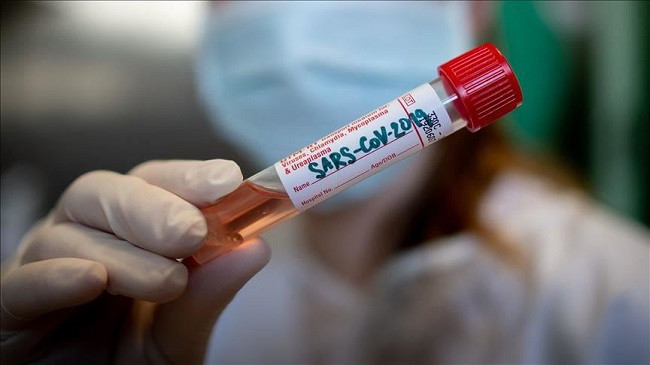 77 raste të reja me koronavirus në Kosovë