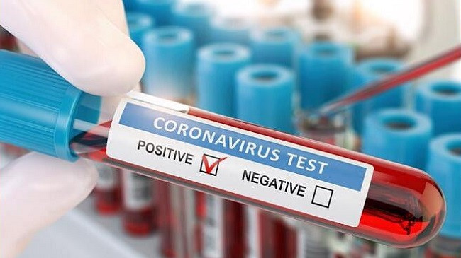 Rritet numri i të infektuarve me koronavirus në Kosovë, 148 raste të reja brenda 24 orëve