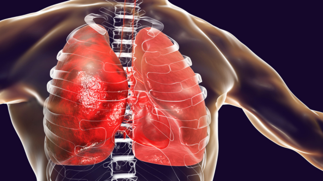 Mit apo fakt, ekspozimi i shpeshtë ndaj ajrit të ftohtë mund të shkaktojë pneumoni?!